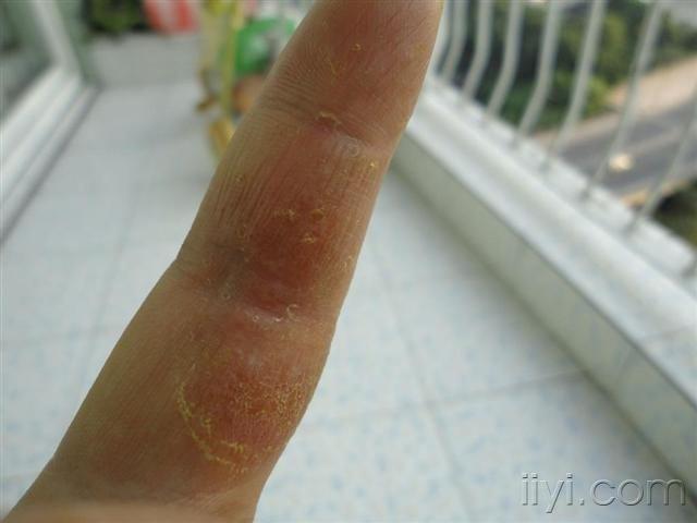 双手指顽固性湿疹