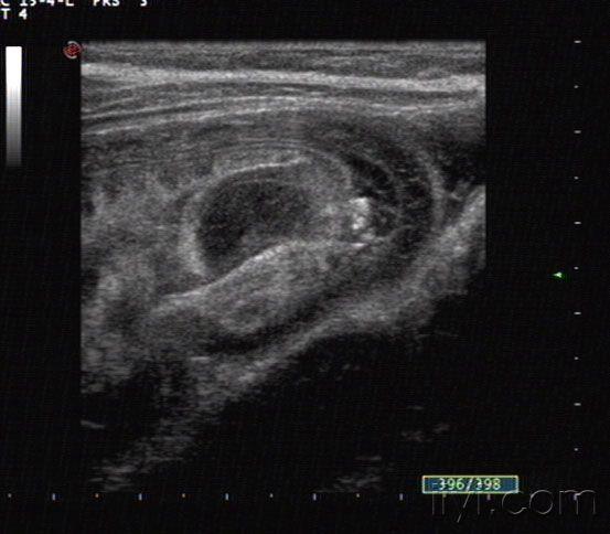 肠套叠 - 超声医学讨论版 - 爱爱医医学论坛 - 爱爱医