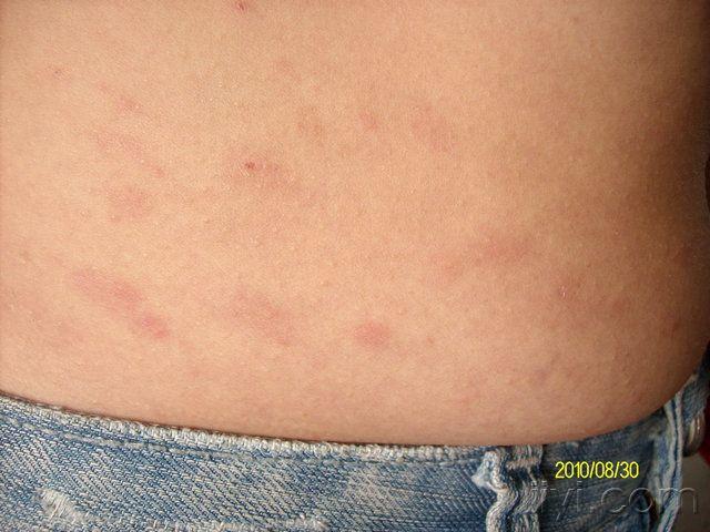 玫瑰糠疹多是持续皮疹,无时隐时现现象 2二期梅毒疹(冶游史?