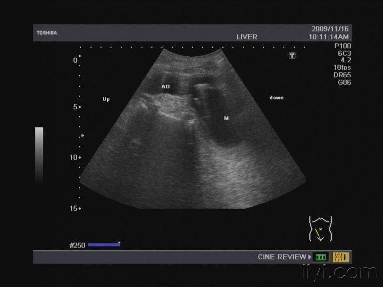 腹主动脉图像 - 超声医学讨论版 - 爱爱医医学论坛-医