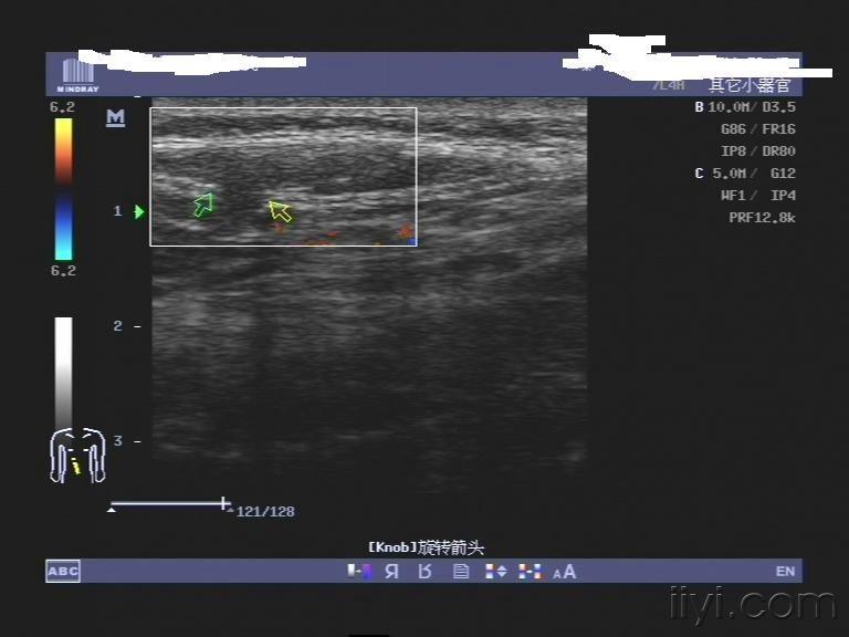 漂亮的白线疝 - 超声医学资源版 - 爱爱医医学论坛