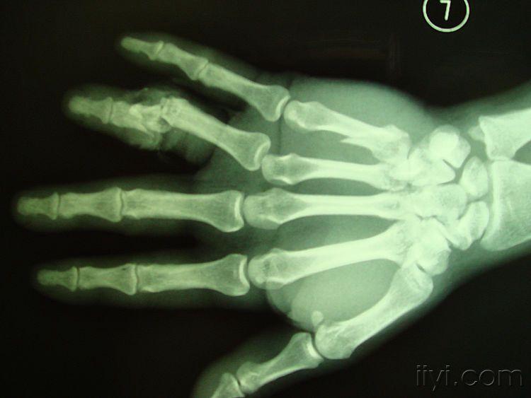 活动受限.伤口渗血. 左手第5掌骨基底处压痛,有异常活动及骨擦感.