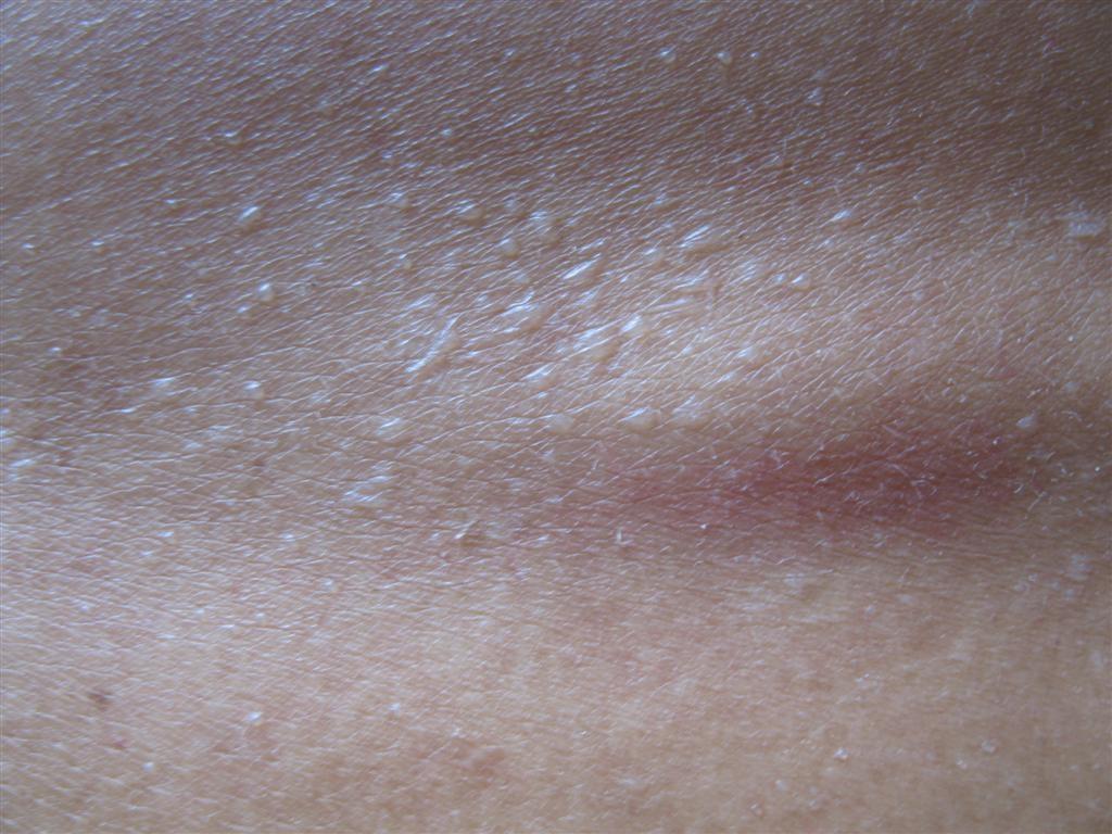 不明原因的皮肤水疱-----晶形粟粒疹