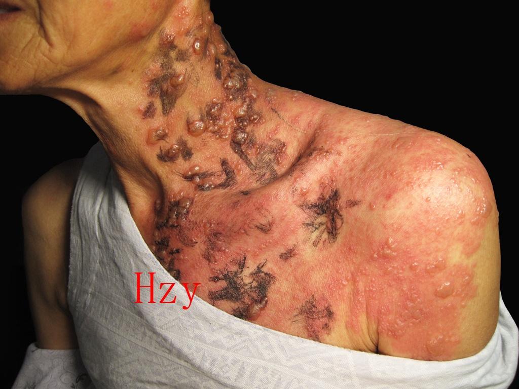 75岁老太太左颈及朐肩部皮损五天.公布答案:带状疱疹