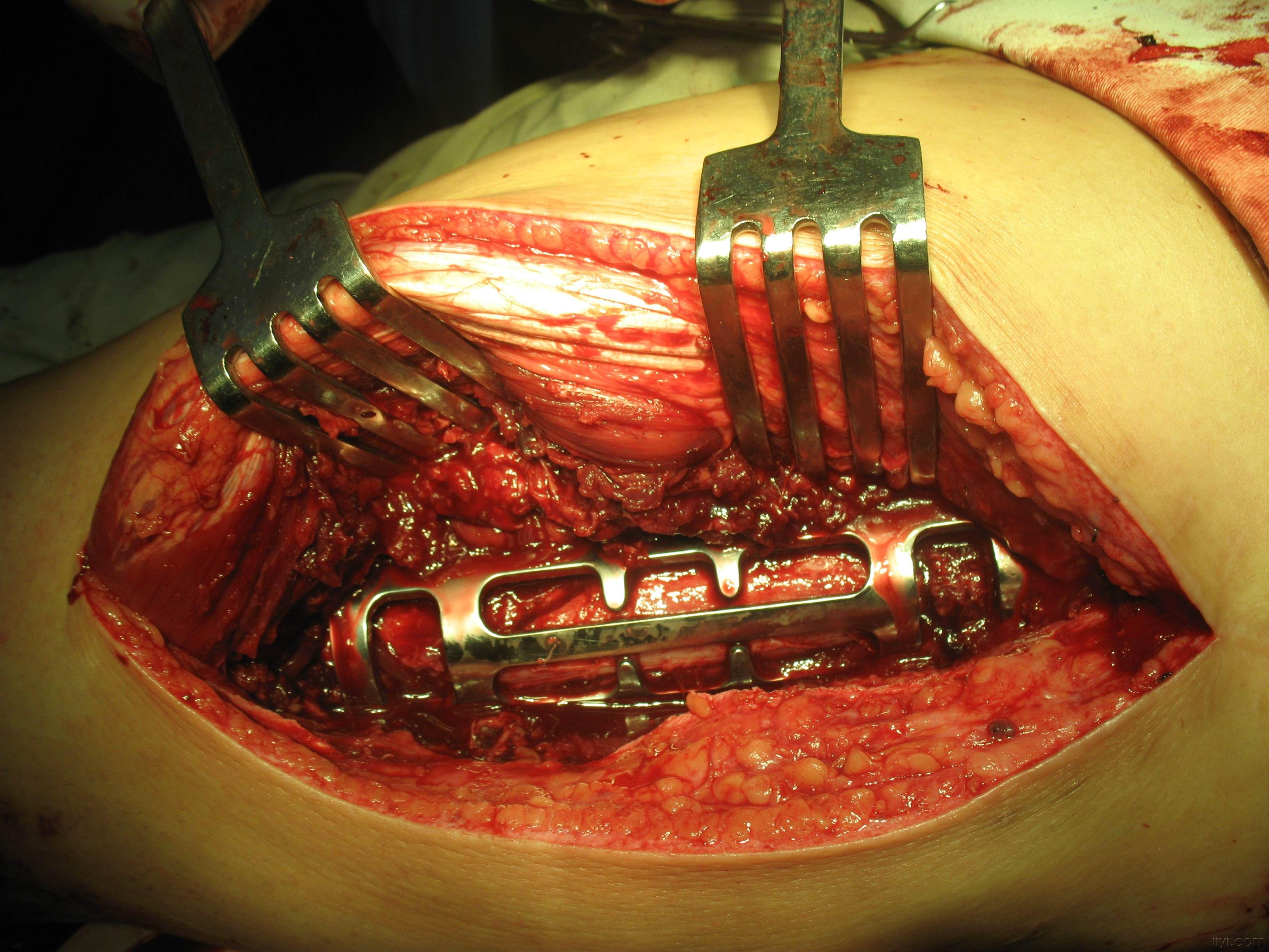 全髋关节置换术后股骨再骨折手术一例
