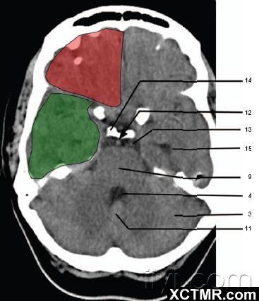 楼主ysp20092010-10-14 14:18:27     1蝶窦(sphenoid sinus)  2