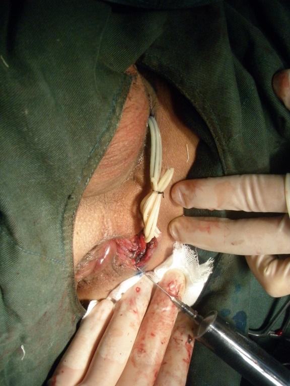 肛瘘断管挂线术