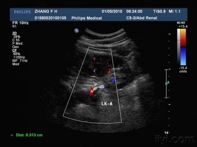 肾动脉狭窄图 超声医学讨论版 爱爱医医学论坛 爱爱医医学网