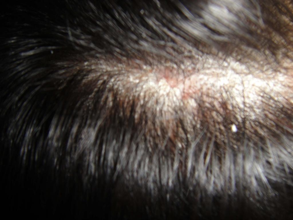 板凳回复liweize2010-11-01 21:23:28考虑脂溢性皮炎 4楼回复ice12010