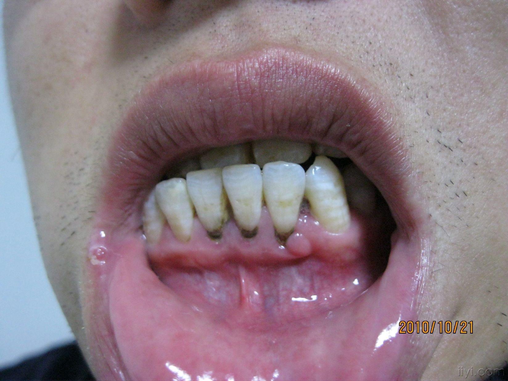 牙龈上的突起是什么