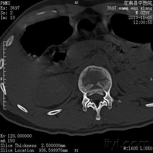 牛人这样也没症状 腰1椎体爆裂性骨折