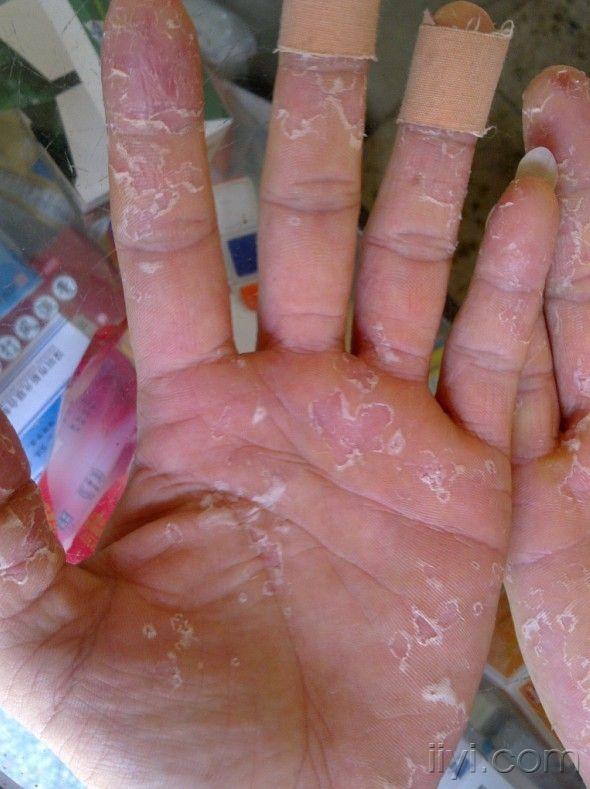 手足脱皮1周 皮肤及性传播疾病讨论版 爱爱医医学论坛-爱爱医医学
