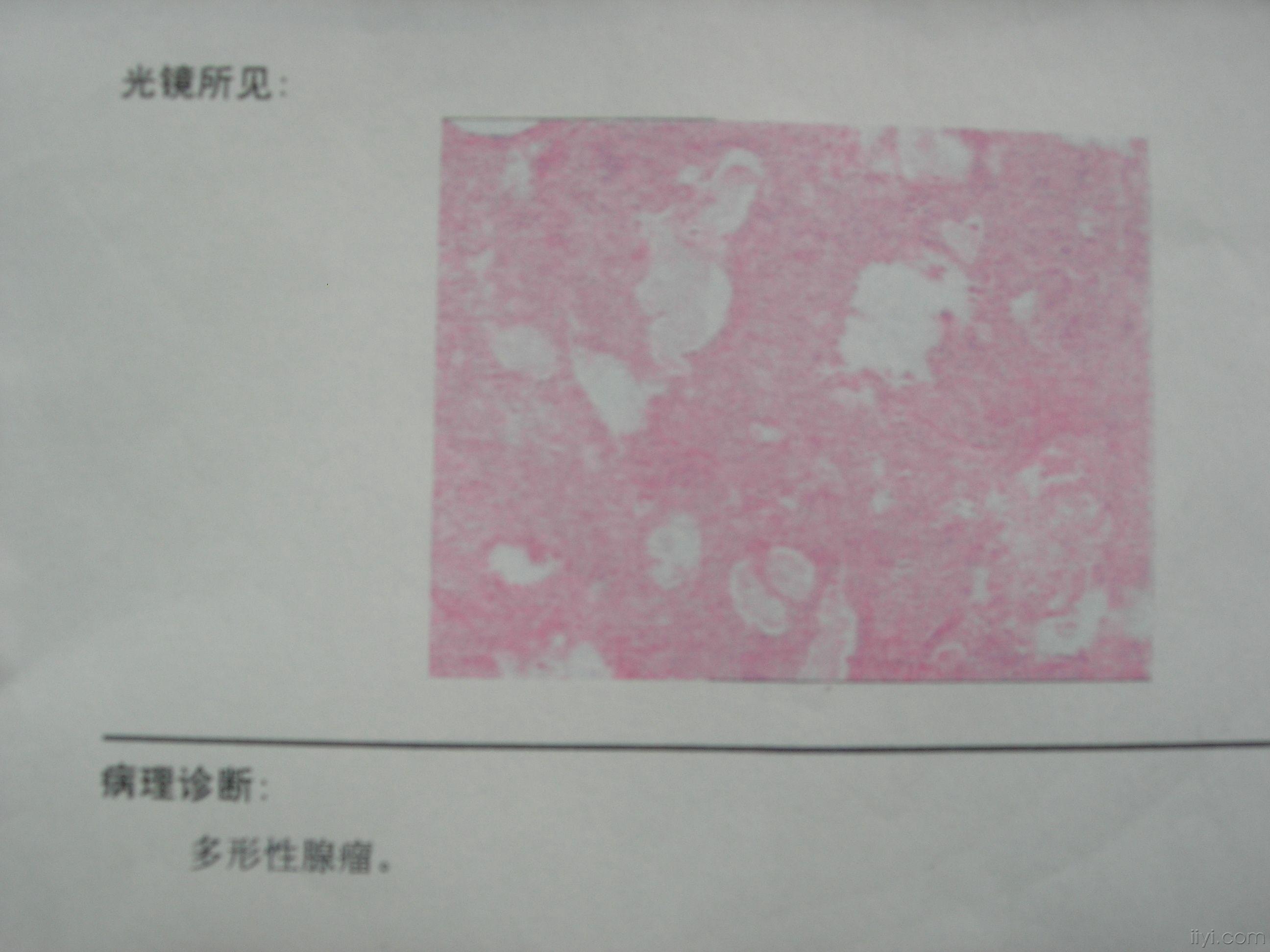 典型腮腺多形性腺瘤一例