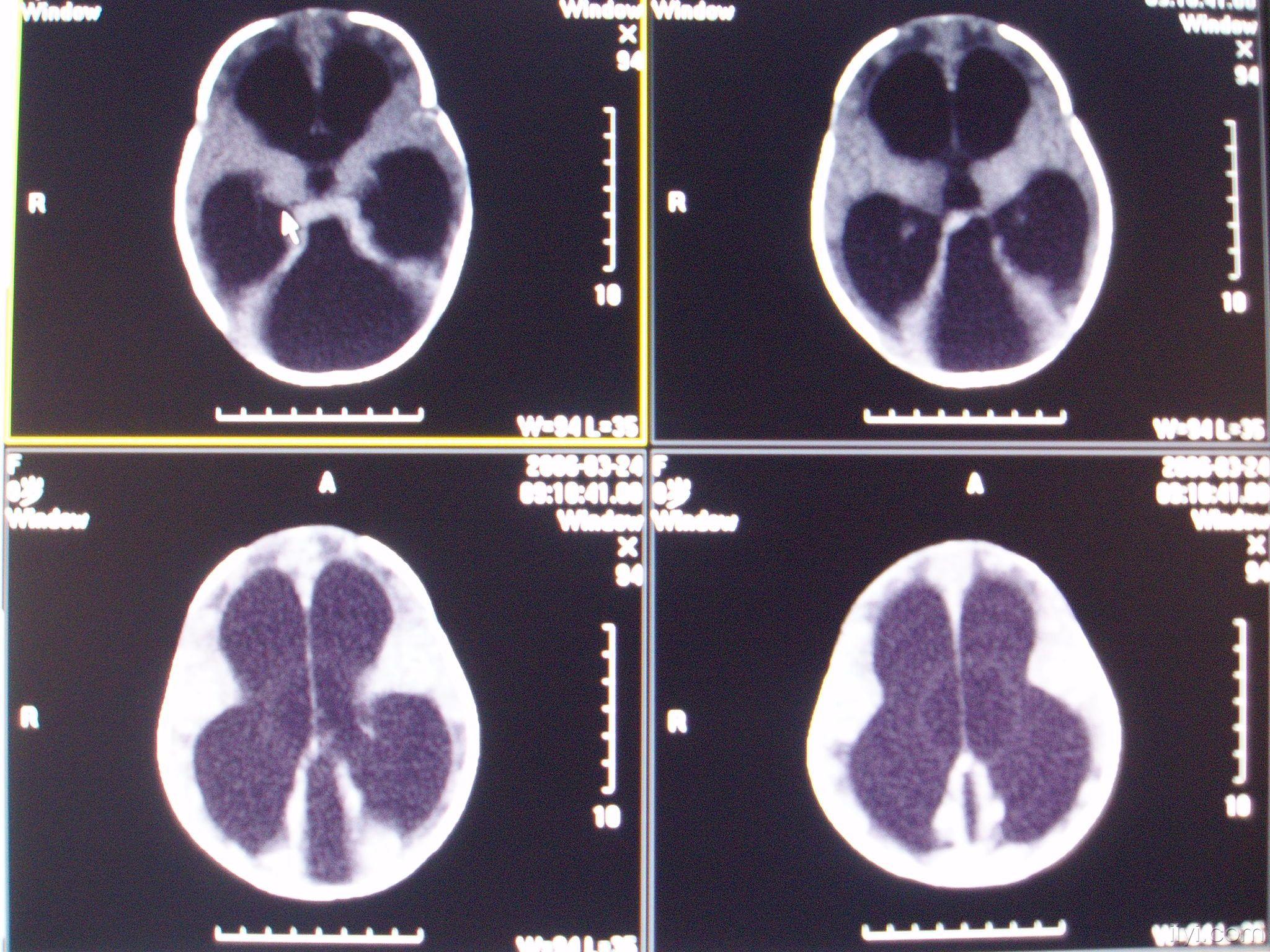 并相互交通,小脑蚓部缺如,第三脑室及双侧侧脑室异常扩张
