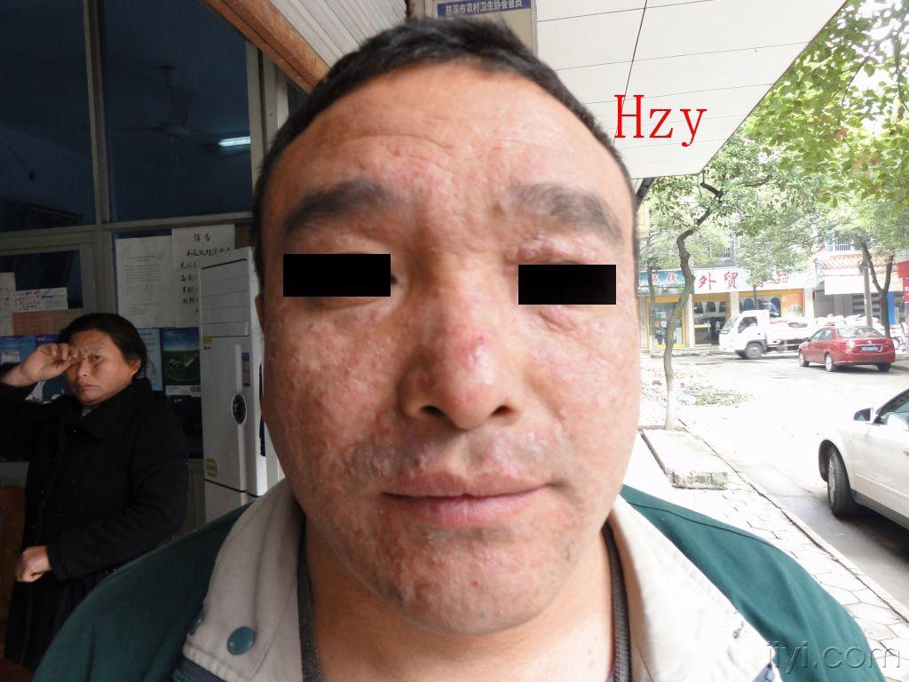 脸部皮损在其它医院诊断为皮炎,越治越重,已半年.