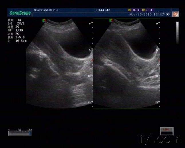 纵隔子宫 超声医学讨论版 爱爱医医学论坛 爱爱医医学网
