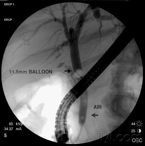 ercp经典图片 - 肝胆外科讨论版 - 爱爱医医学论坛-爱爱医医学网