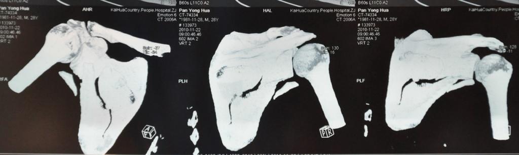右肩胛骨粉碎性骨折
