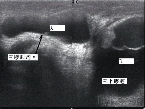 左下腹,左侧腹股沟囊性回声团