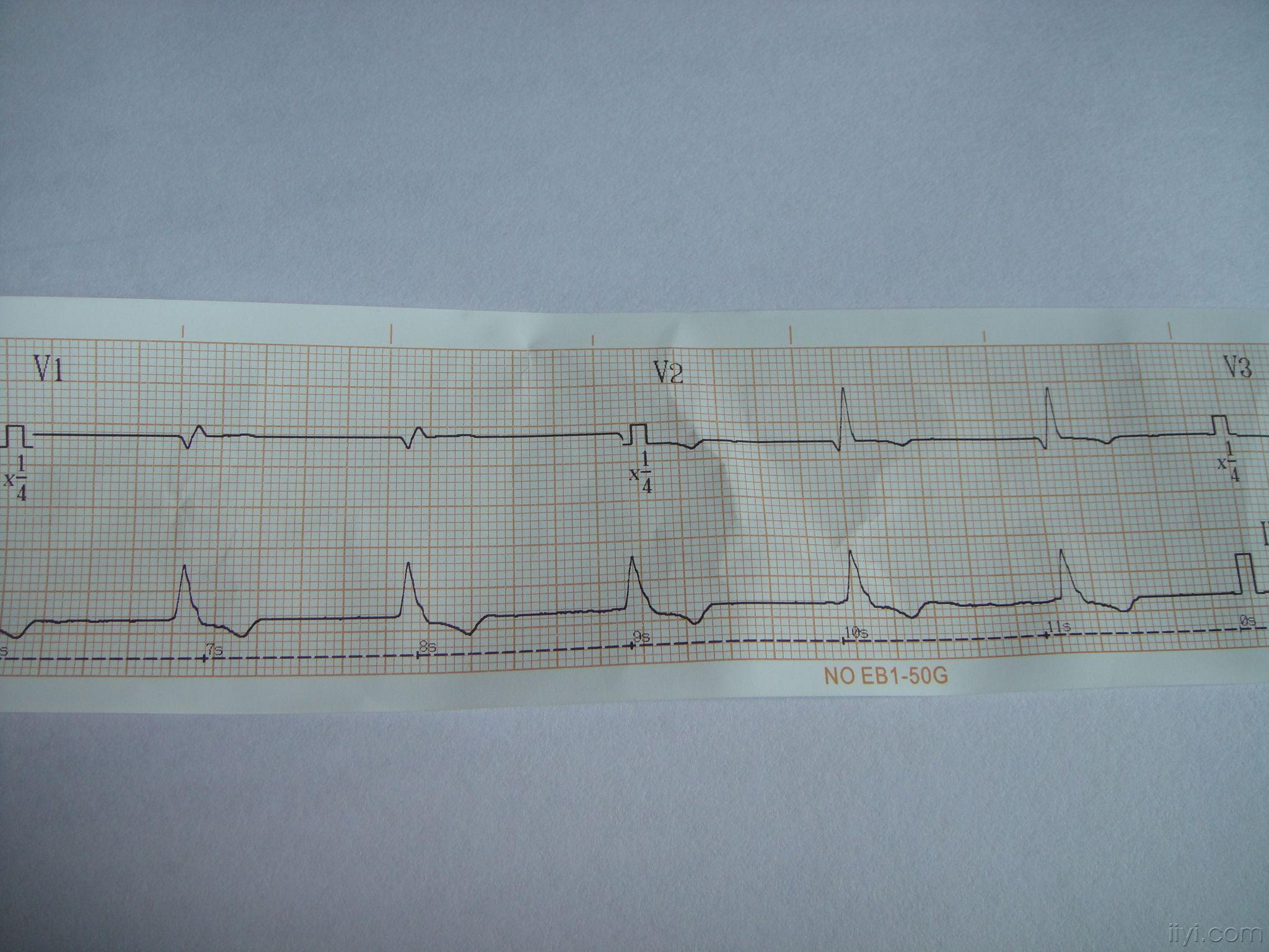 交界性逸搏心律?