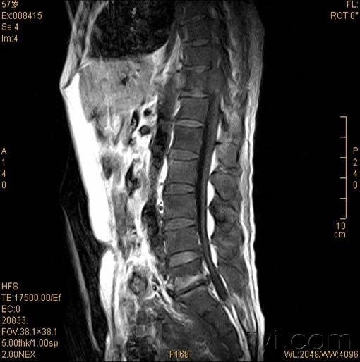 4楼回复wwsh901回复 wwsh901 胸腰椎mri检查提示:t11椎体病理性