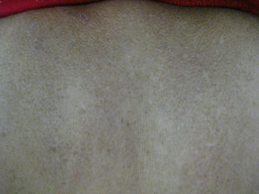 背部斑状淀粉样变性 - 皮肤及性传播疾病讨论版 - 医
