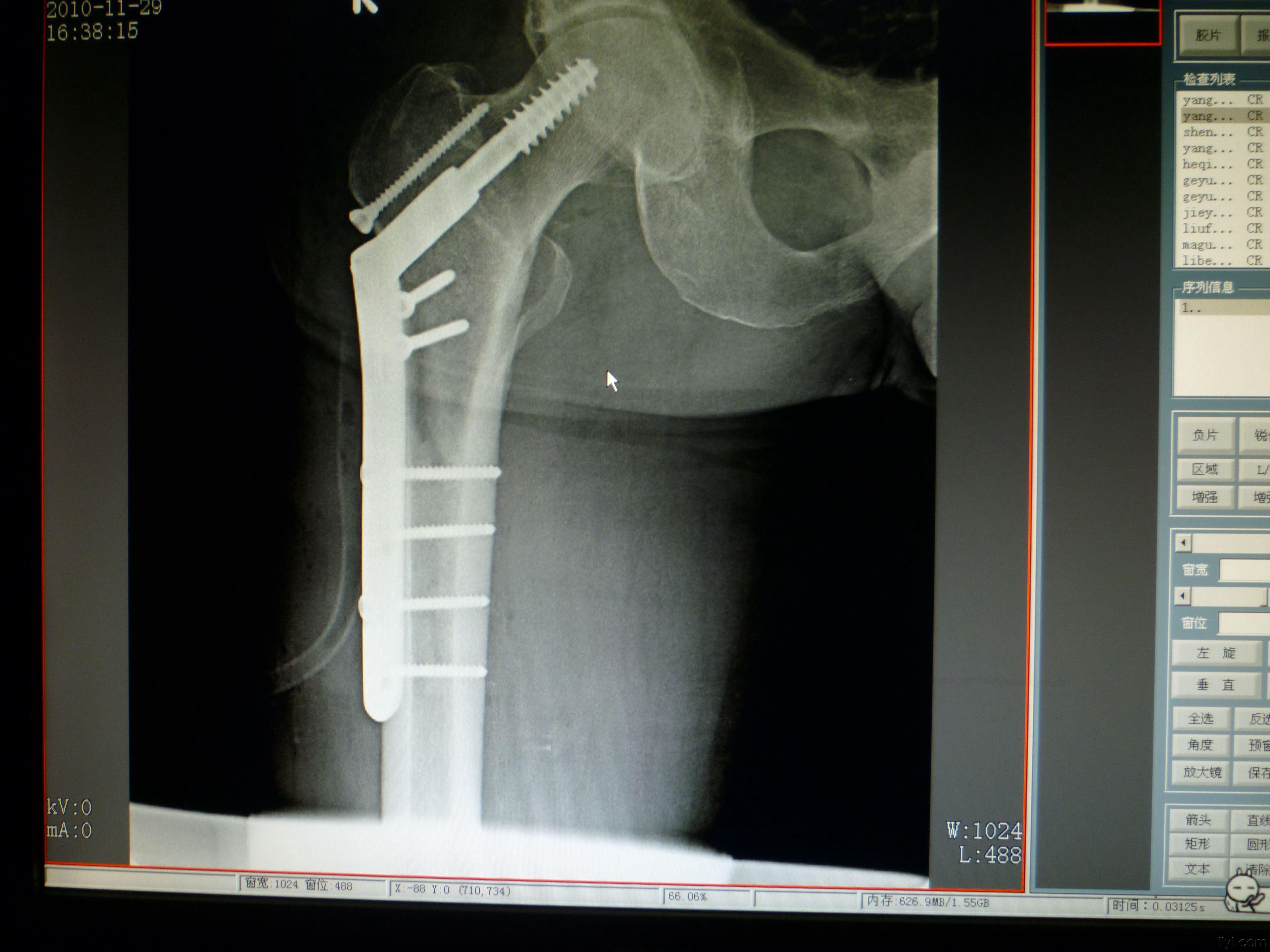 dhs与股骨近端钢板治疗粗隆骨折 两例