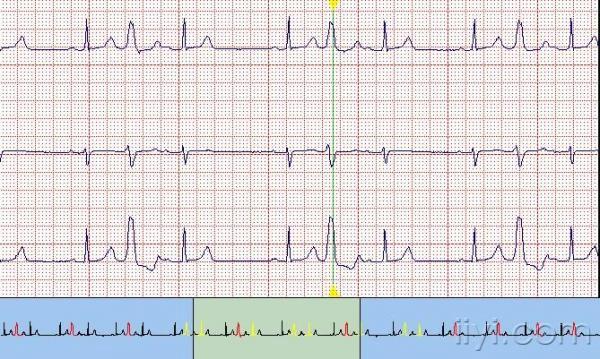 间位室早? - 心电图脑电图专业讨论版 - 爱爱医医学