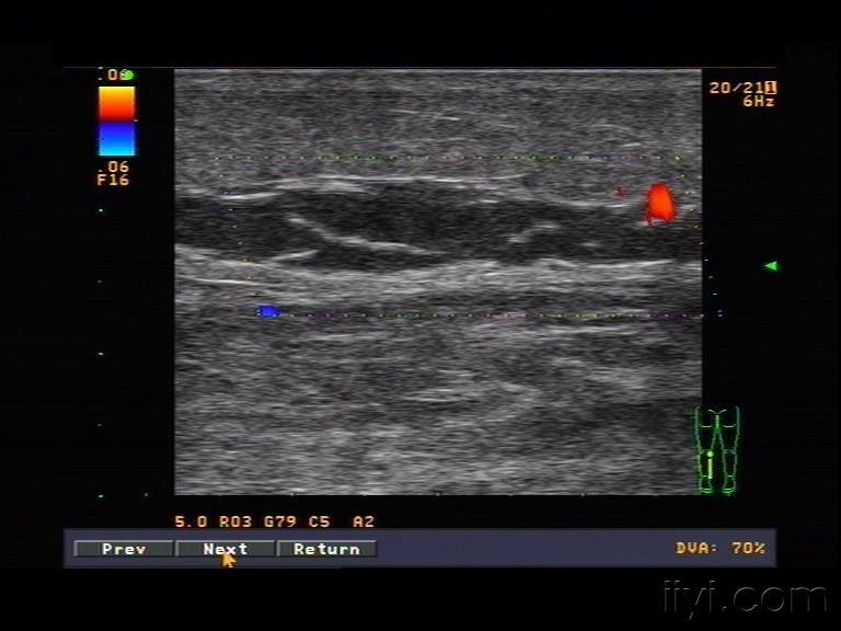 小腿腓肠肌肌间静脉血栓 超声医学讨论版 爱爱医医学论坛 爱爱