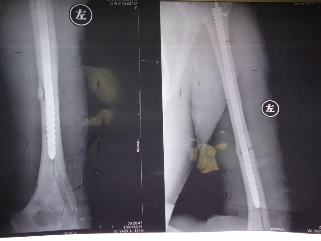 两个月前在一家医院就诊,经行x光片检  查,诊断为骨不连,骨囊肿形成