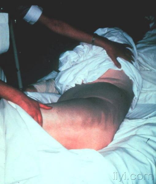 出血患者脐周皮肤颜色改变的描述[2>,后来这一体征被命名为cullen征