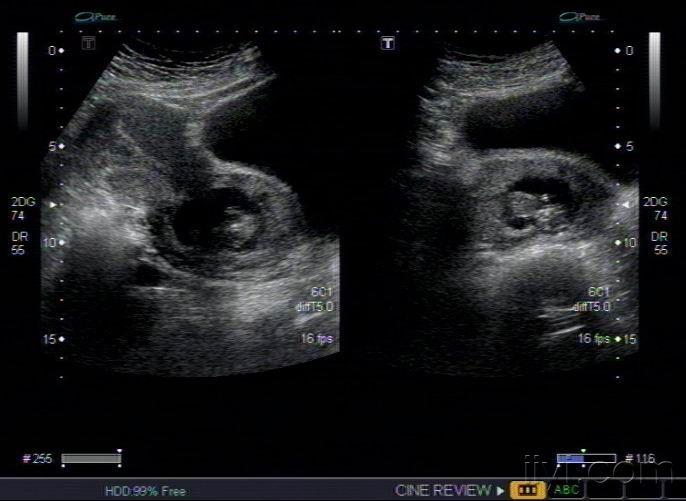 超声示:子宫前位增大,肌层回声不均,宫腔内可见范围约3.1x1.4x3.