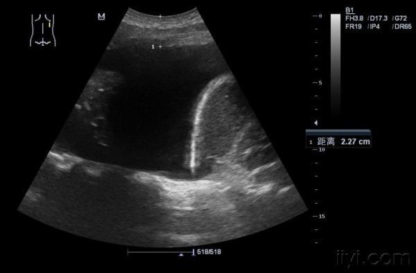 胸腔积液超声图像请教