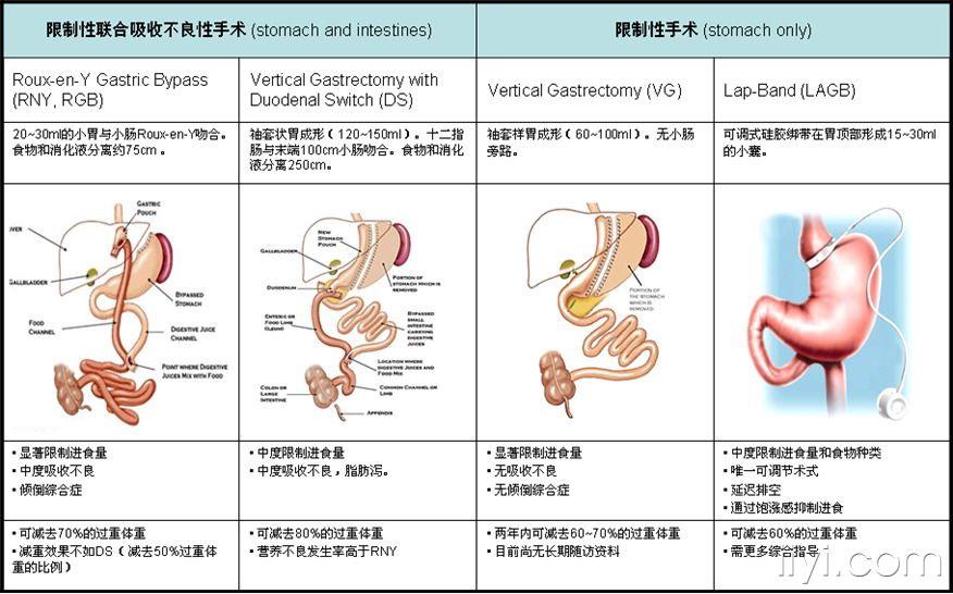 肥胖症的外科治疗