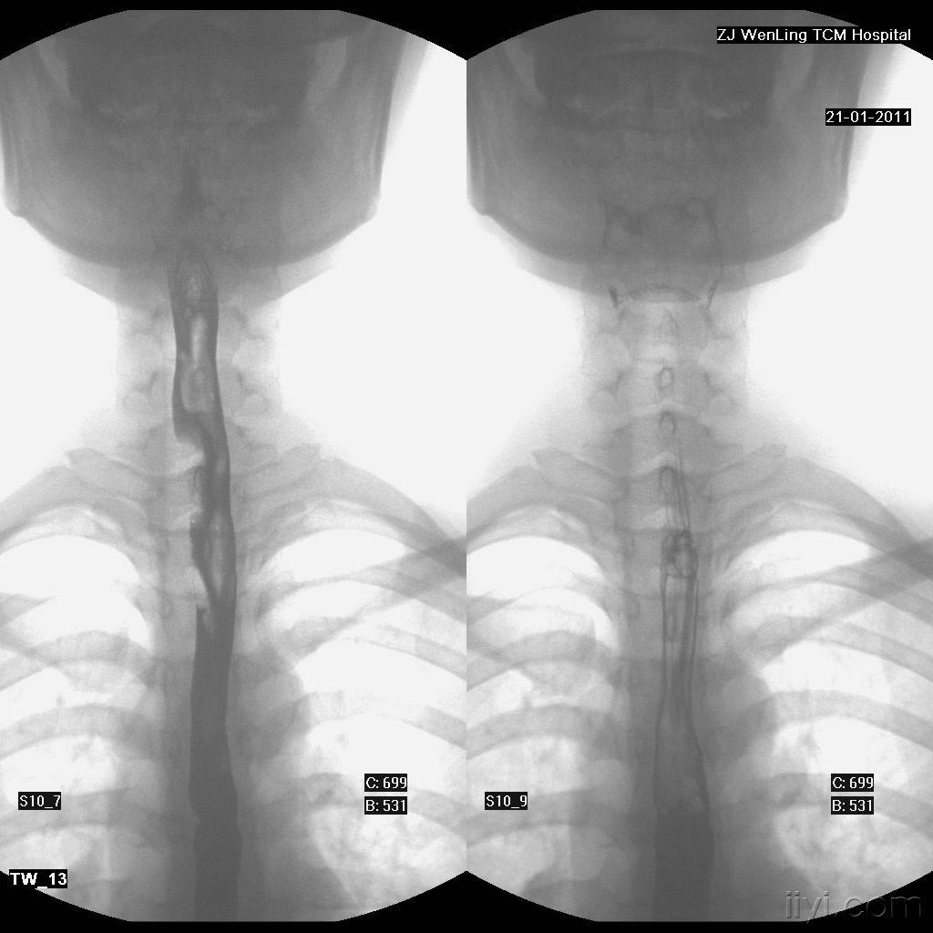 求助-食道钡灌充盈缺损