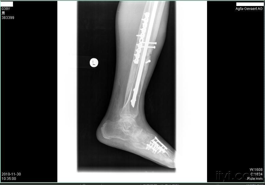 左胫骨骨折交锁髓内钉内固定术后一年骨不连