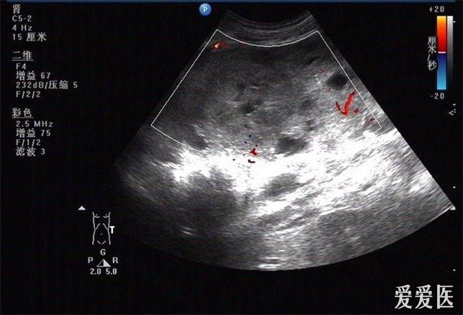 肾癌患者超声图片
