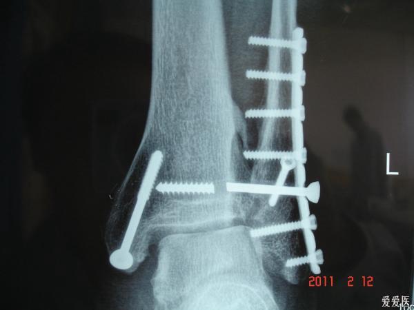 21:28:35患者男性,18岁,体重100kg以上,双踝骨折伴下胫腓联合分离,术