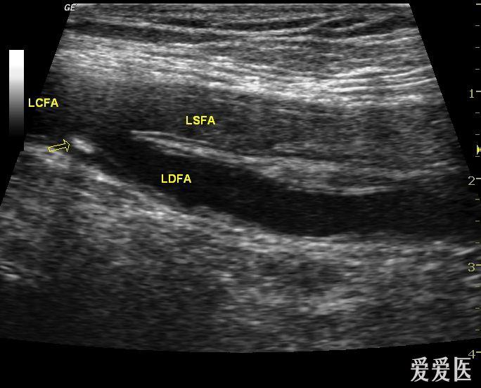 股浅动脉血栓栓塞 - 超声医学讨论版 - 爱爱医医学论坛 - 爱爱医医学