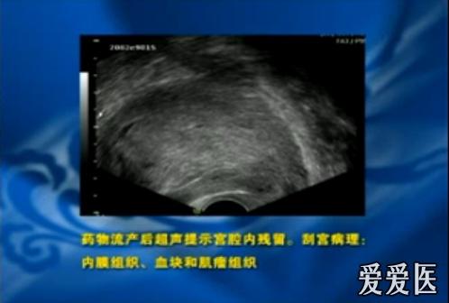 宫内残留,我报子宫肌瘤玻璃样变.