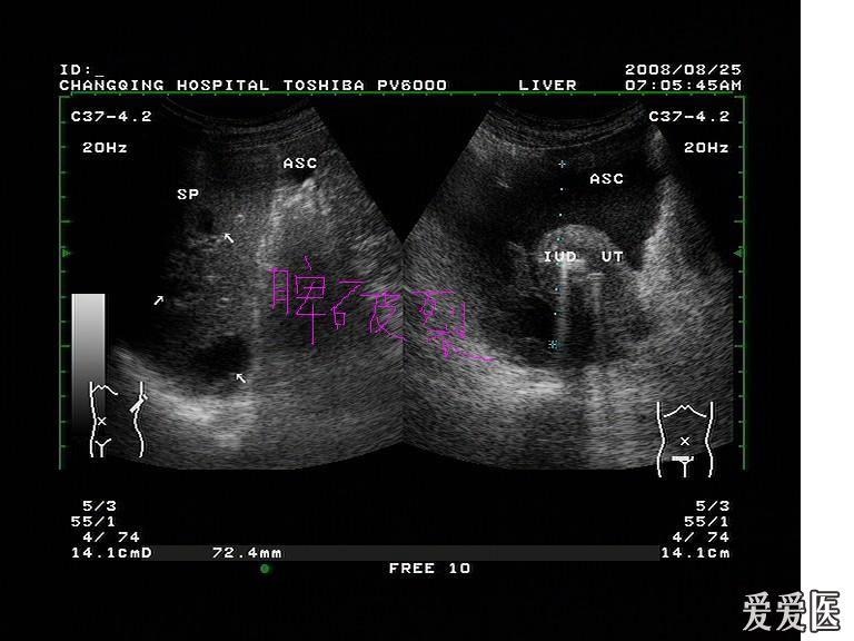 脾破裂 - 超声医学讨论版 - 爱爱医医学论坛-爱爱医