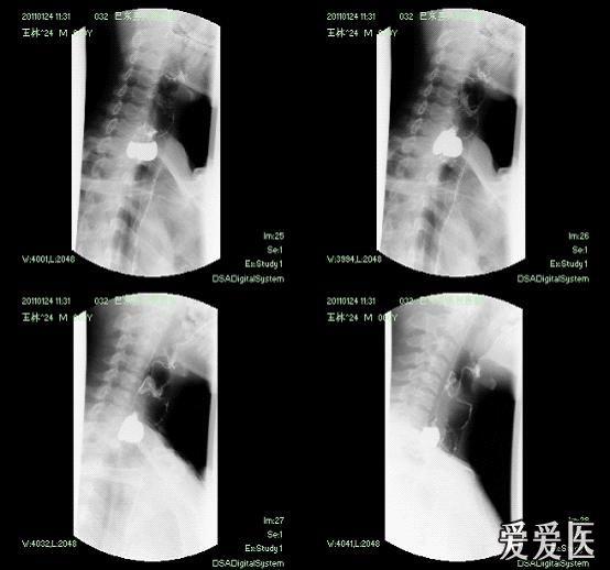 咽食管憩室 - 医学影像学资源版 - 爱爱医医学论坛-医