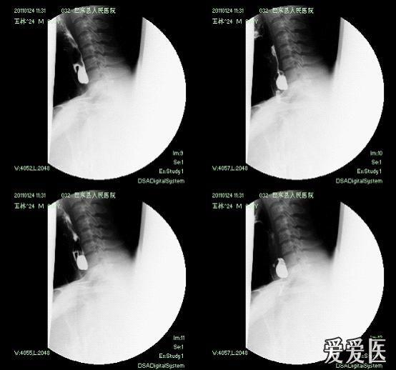 咽食管憩室 - 医学影像学资源版 - 爱爱医医学论坛-医