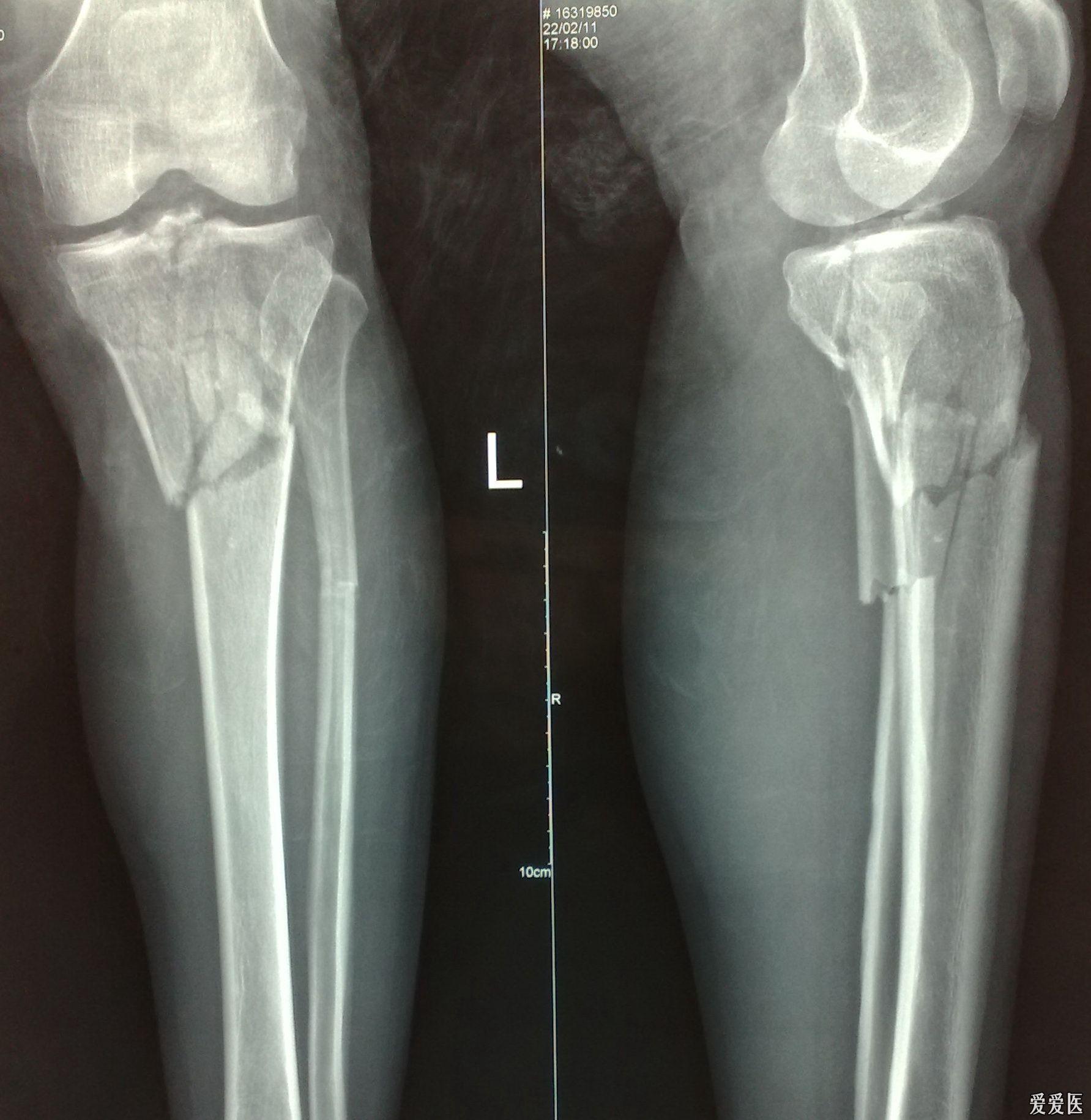 左胫骨上段粉碎性骨折 这个手术怎么作?
