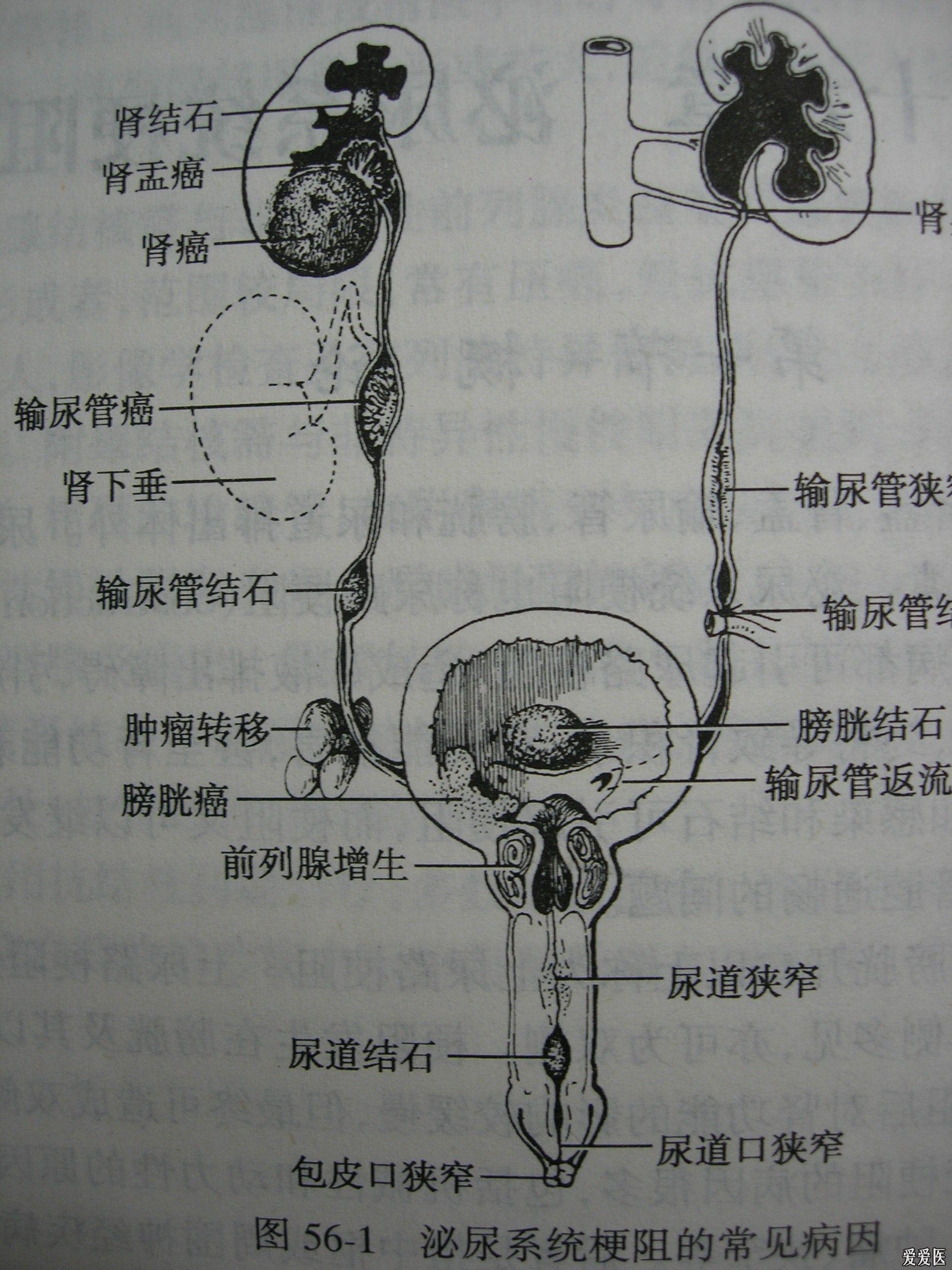 泌尿系梗阻的常见病因