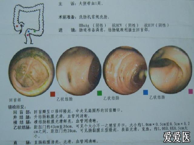 结肠憩室病并出血