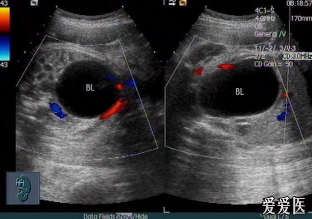 胎儿巨大膀胱声像图——zengerya十三贴