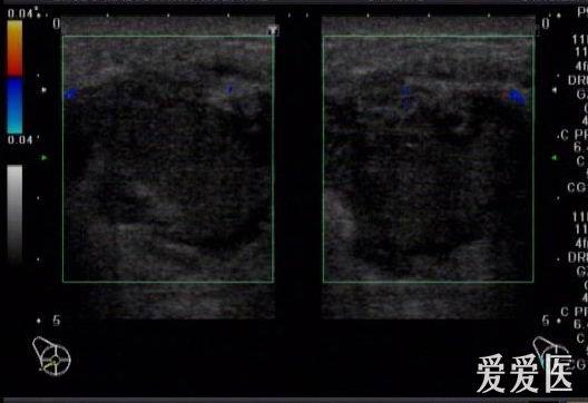 急性乳腺炎伴脓肿形成 超声医学讨论版 爱爱医医学论坛 爱爱医