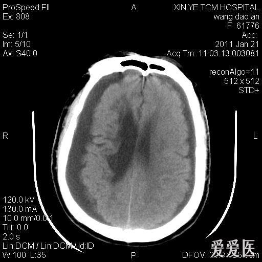 一例慢性硬膜下血肿治疗前后的感慨