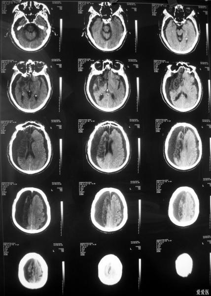 大面积脑梗塞后硬膜下积液一例,四个月后并发慢性硬膜下血肿,请看14楼